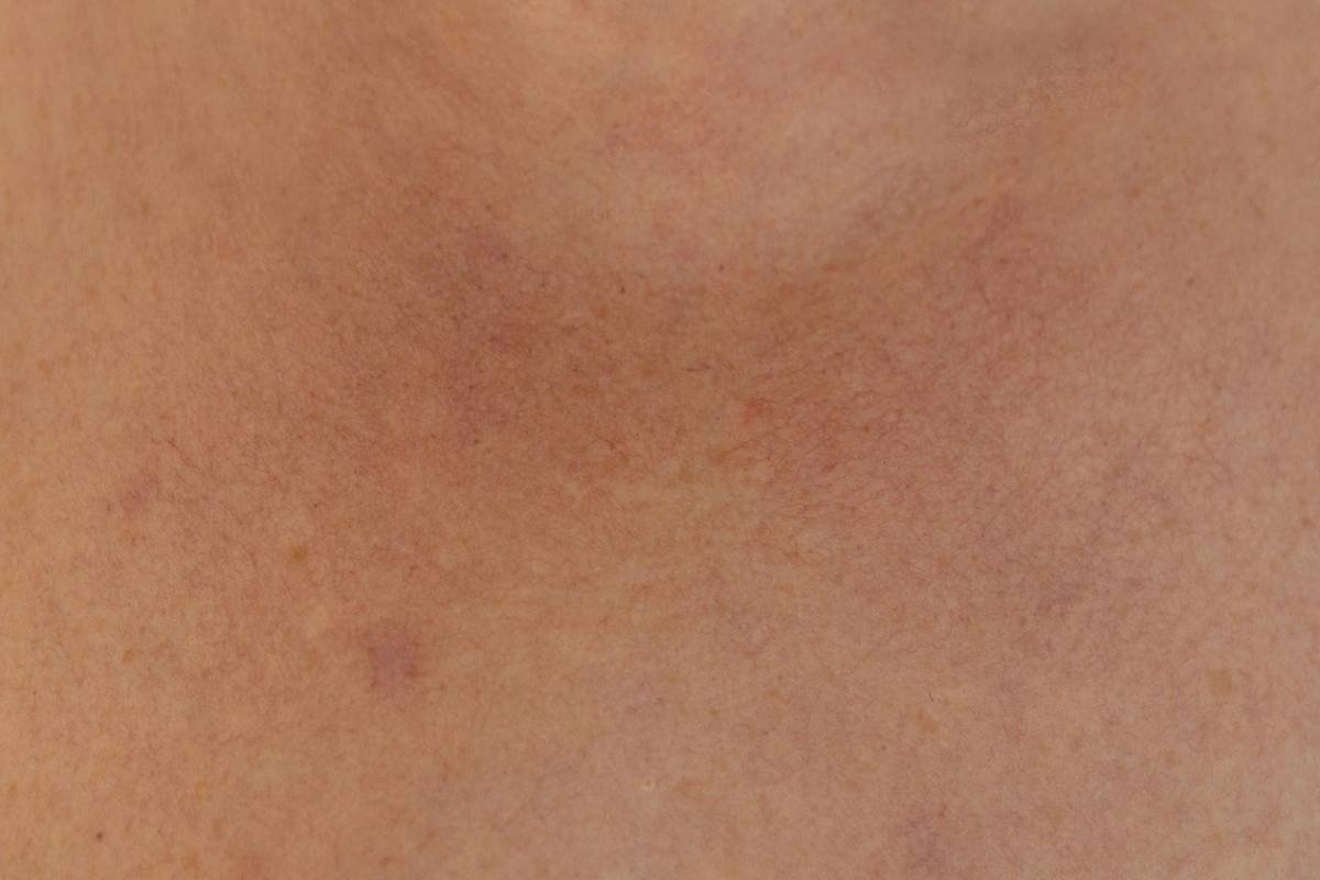 Chart showing common mold types linked to skin rashes: Aspergillus (30%), Cladosporium (25%), Stachybotrys (20%), Penicillium (15%), Other (10%)